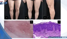 Reportan psoriasis lineal inducida por fármaco en paciente con prurito nodular refractario