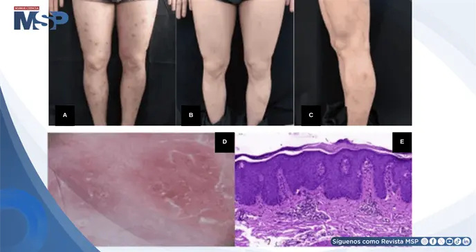 Reportan psoriasis lineal inducida por f&aacute;rmaco en paciente con prurito nodular refractario