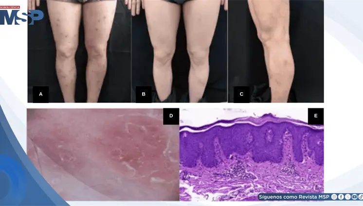 Reportan psoriasis lineal inducida por f&aacute;rmaco en paciente con prurito nodular refractario
