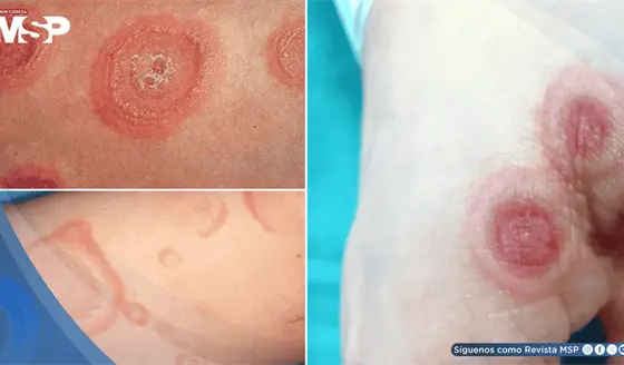 Lesiones en diana, ampollas y fiebre: As&iacute; se presenta el eritema multiforme