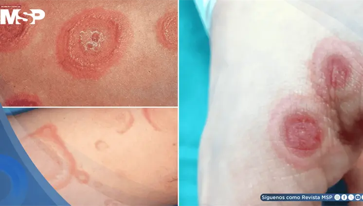 Lesiones en diana, ampollas y fiebre: As&iacute; se presenta el eritema multiforme
