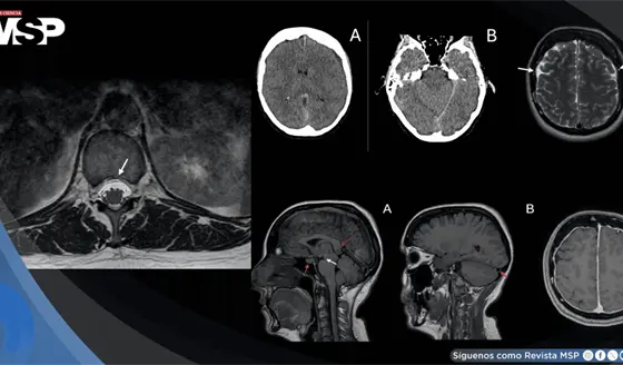 Hipotensi&oacute;n intracraneal y cefalea ortost&aacute;tica caus&oacute; sangrado cerebral y fuga de l&iacute;quido cefalorraqu&iacute;deo