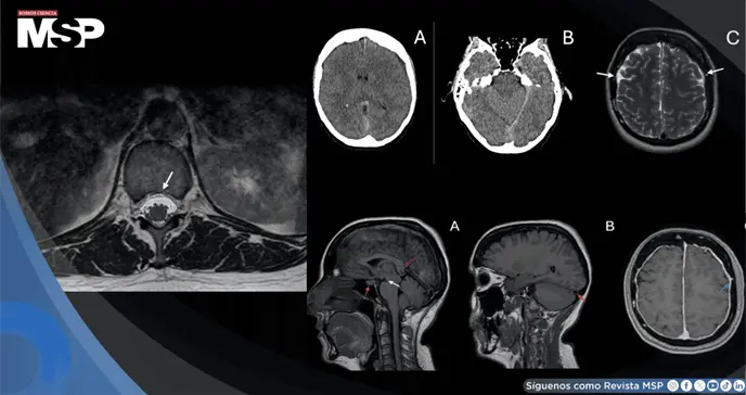 Hipotensi&oacute;n intracraneal y cefalea ortost&aacute;tica caus&oacute; sangrado cerebral y fuga de l&iacute;quido cefalorraqu&iacute;deo