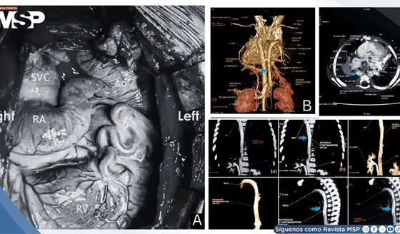 Desaturaci&oacute;n sist&eacute;mica temprana tras operaci&oacute;n de Kawashima revela malformaciones veno-venosas