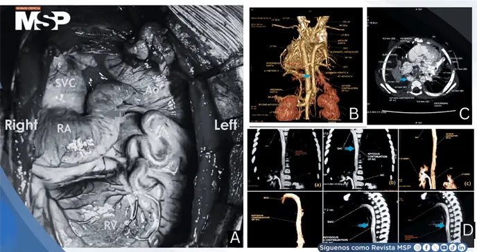 Desaturación sistémica temprana tras operación de Kawashima revela malformaciones veno-venosas Desaturación sistémica temprana tras operación de Kawashima revela malformaciones veno-venosas