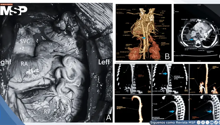 Desaturación sistémica temprana tras operación de Kawashima revela malformaciones veno-venosas Desaturación sistémica temprana tras operación de Kawashima revela malformaciones veno-venosas