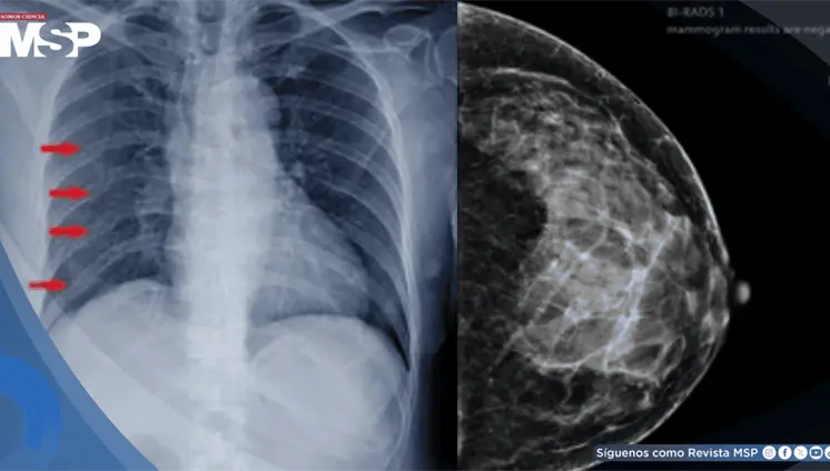 M&uacute;ltiples fracturas costales por osteorradionecrosis como secuela de la reirradiaci&oacute;n por c&aacute;ncer de mama
