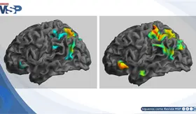 Ketamina sublingual logra remisión completa en paciente con síndrome de cabeza explosiva 
