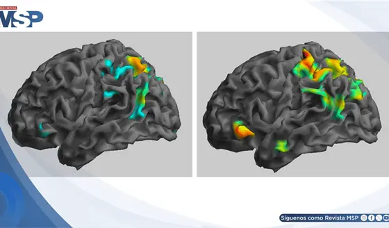 Ketamina sublingual logra remisi&oacute;n completa en paciente con s&iacute;ndrome de cabeza explosiva 
