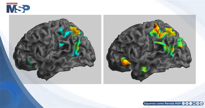 Ketamina sublingual logra remisi&oacute;n completa en paciente con s&iacute;ndrome de cabeza explosiva 