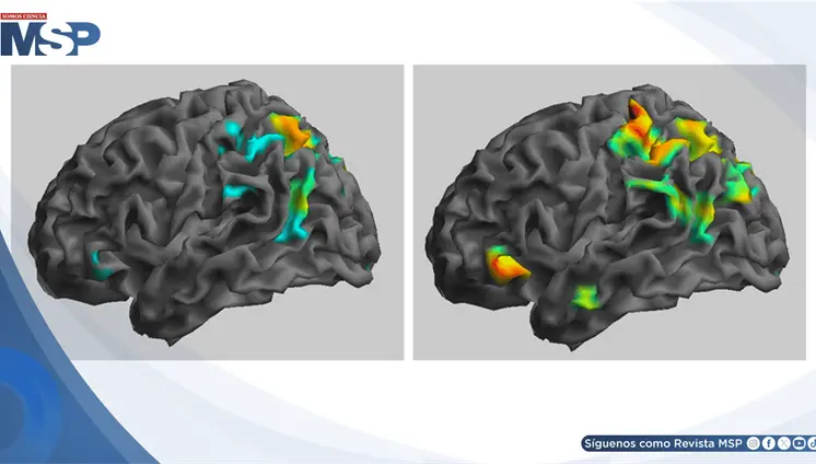 Ketamina sublingual logra remisi&oacute;n completa en paciente con s&iacute;ndrome de cabeza explosiva 