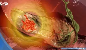 Identifican genes que aumentan el riesgo de c&aacute;ncer de p&aacute;ncreas y permiten detectar poblaci&oacute;n susceptible