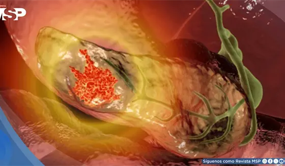 Identifican genes que aumentan el riesgo de c&aacute;ncer de p&aacute;ncreas y permiten detectar poblaci&oacute;n susceptible
