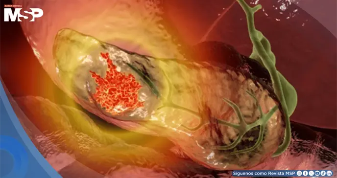 Identifican genes que aumentan el riesgo de cáncer de páncreas y permiten detectar población susceptible Identifican genes que aumentan el riesgo de cáncer de páncreas y permiten detectar población susceptible