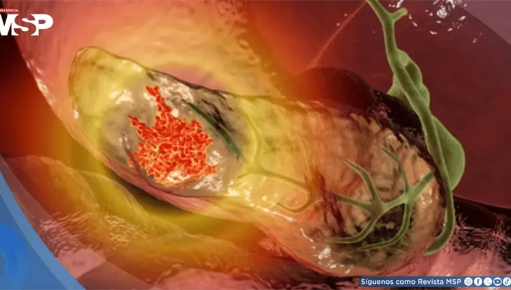 Identifican genes que aumentan el riesgo de cáncer de páncreas y permiten detectar población susceptible Identifican genes que aumentan el riesgo de cáncer de páncreas y permiten detectar población susceptible