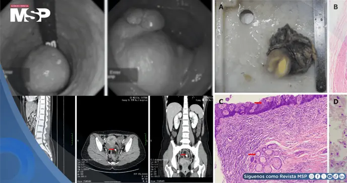 Masa rectal con tejido &oacute;seo y cerebral en mujer gestante es causada por un teratoma rectal maduro