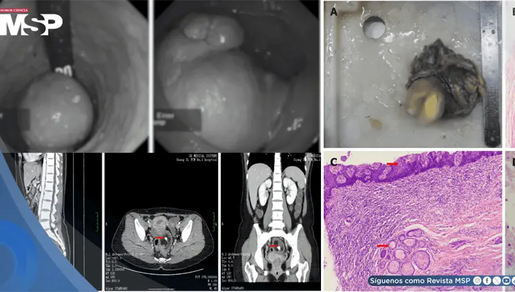 Masa rectal con tejido &oacute;seo y cerebral en mujer gestante es causada por un teratoma rectal maduro
