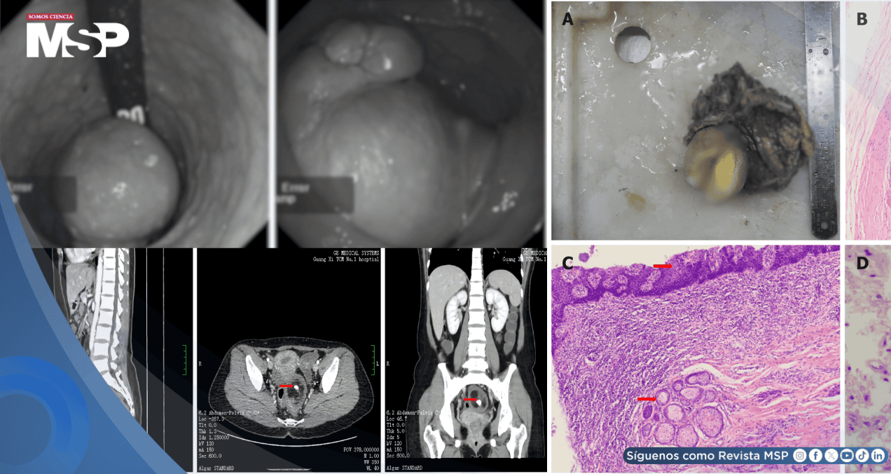 Masa rectal con tejido óseo y cerebral en mujer gestante es causada por un teratoma rectal maduro Masa rectal con tejido óseo y cerebral en mujer gestante es causada por un teratoma rectal maduro
