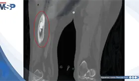 Colapso cardiovascular por s&iacute;ndrome de implantaci&oacute;n de cemento &oacute;seo durante artroplastia de cadera