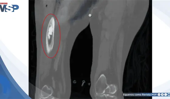 Colapso cardiovascular por s&iacute;ndrome de implantaci&oacute;n de cemento &oacute;seo durante artroplastia de cadera
