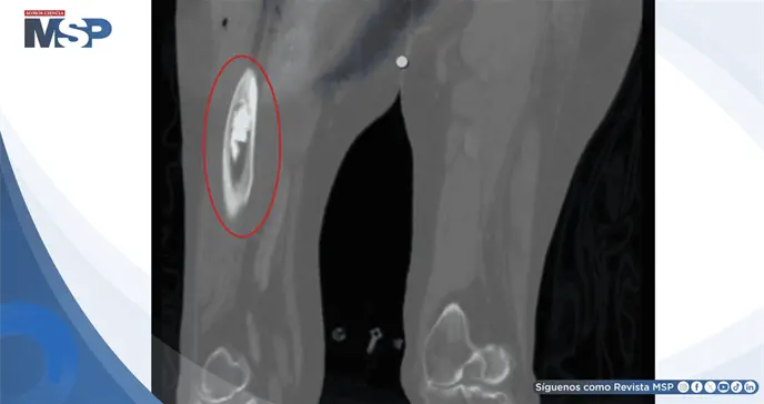 Colapso cardiovascular por s&iacute;ndrome de implantaci&oacute;n de cemento &oacute;seo durante artroplastia de cadera