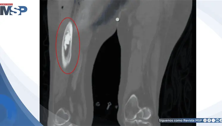 Colapso cardiovascular por s&iacute;ndrome de implantaci&oacute;n de cemento &oacute;seo durante artroplastia de cadera