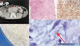 Pseudotumor de c&eacute;lulas fusiformes micobacteriano simul&oacute; linfoma abdominal en paciente con VIH cong&eacute;nito