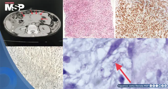 Pseudotumor de células fusiformes micobacteriano simuló linfoma abdominal en paciente con VIH congénito