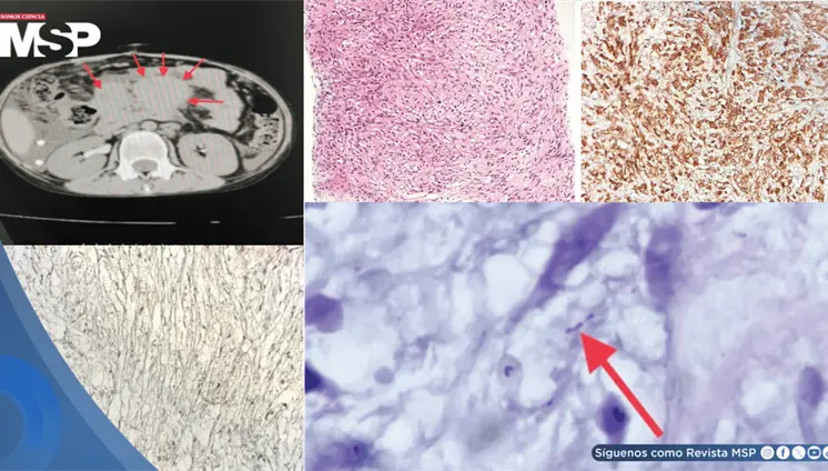 Pseudotumor de c&eacute;lulas fusiformes micobacteriano simul&oacute; linfoma abdominal en paciente con VIH cong&eacute;nito
