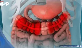 &iquest;Gases en exceso, hinchaz&oacute;n abdominal y diarrea? Podr&iacute;an ser se&ntilde;ales del s&iacute;ndrome de intestino irritable