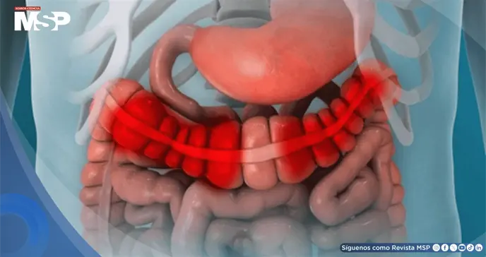 &iquest;Gases en exceso, hinchaz&oacute;n abdominal y diarrea? Podr&iacute;an ser se&ntilde;ales del s&iacute;ndrome de intestino irritable