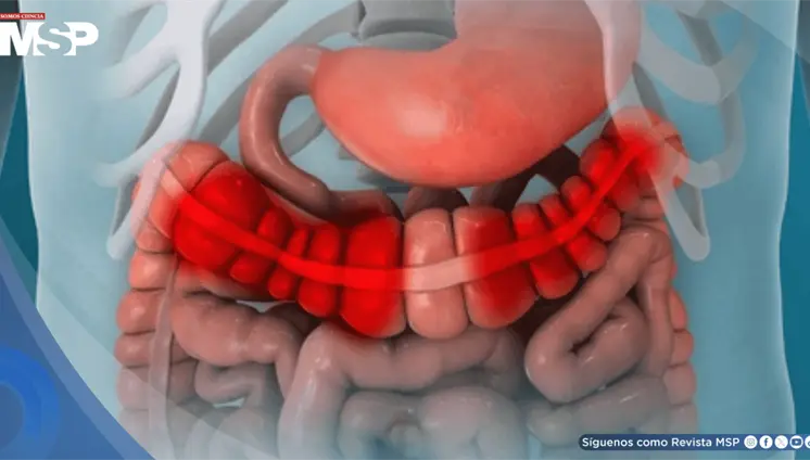¿Gases en exceso, hinchazón abdominal y diarrea? Podrían ser señales del síndrome de intestino irritable ¿Gases en exceso, hinchazón abdominal y diarrea? Podrían ser señales del síndrome de intestino irritable