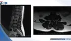 Tratamiento con ejercicio PKE logra recuperaci&oacute;n funcional en hernia discal lumbar con ciatalgia