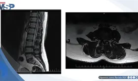 Tratamiento con ejercicio PKE logra recuperaci&oacute;n funcional en hernia discal lumbar con ciatalgia