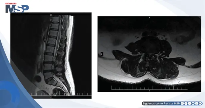 Tratamiento con ejercicio PKE logra recuperaci&oacute;n funcional en hernia discal lumbar con ciatalgia