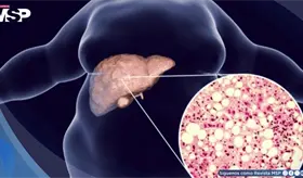 Cansancio persistente y dolor en el abdomen: S&iacute;ntomas que podr&iacute;an revelar h&iacute;gado graso no alcoh&oacute;lico