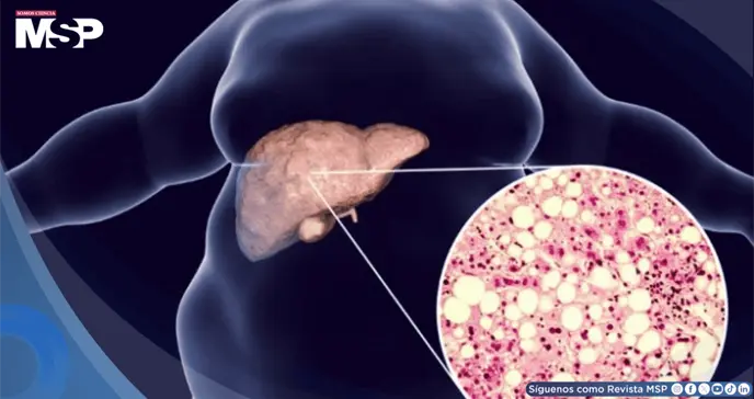 Cansancio persistente y dolor en el abdomen: S&iacute;ntomas que podr&iacute;an revelar h&iacute;gado graso no alcoh&oacute;lico