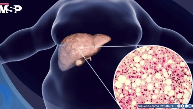 Cansancio persistente y dolor en el abdomen: S&iacute;ntomas que podr&iacute;an revelar h&iacute;gado graso no alcoh&oacute;lico
