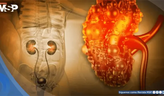 Un an&aacute;lisis de sangre "normal" podr&iacute;a ocultar un alto riesgo de enfermedad renal, seg&uacute;n estudio