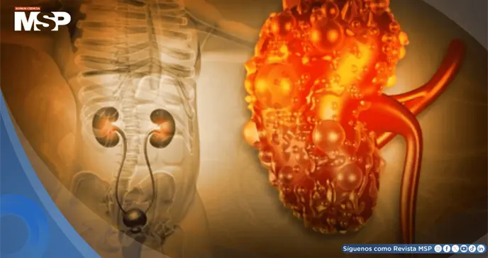 Un an&aacute;lisis de sangre "normal" podr&iacute;a ocultar un alto riesgo de enfermedad renal, seg&uacute;n estudio