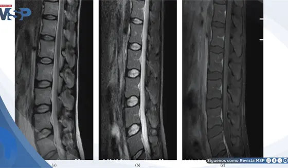 Detectan mielitis transversa aguda con afectaci&oacute;n medular extensa en mujer con lupus previamente estable