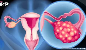 Menstruaciones irregulares, vello facial y problemas de fertilidad: S&iacute;ndrome de ovario poliqu&iacute;stico