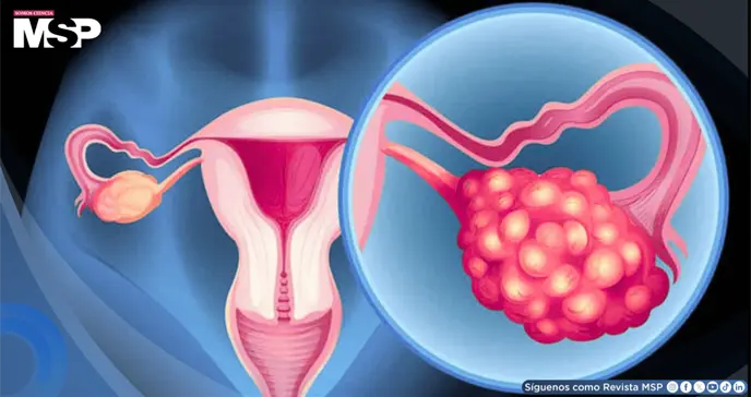 Menstruaciones irregulares, vello facial y problemas de fertilidad: S&iacute;ndrome de ovario poliqu&iacute;stico
