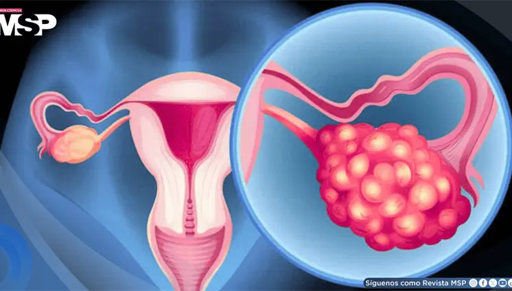 Menstruaciones irregulares, vello facial y problemas de fertilidad: S&iacute;ndrome de ovario poliqu&iacute;stico