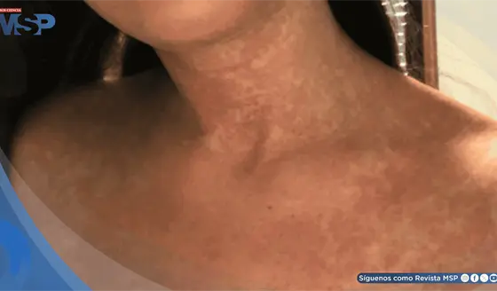 Fiebre y rigidez cervical por uso de trimetoprim-sulfametoxazol imit&oacute; meningitis en mujer con una ITU
