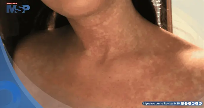 Fiebre y rigidez cervical por uso de trimetoprim-sulfametoxazol imit&oacute; meningitis en mujer con una ITU