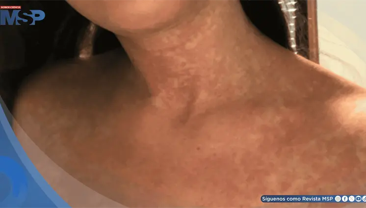 Fiebre y rigidez cervical por uso de trimetoprim-sulfametoxazol imit&oacute; meningitis en mujer con una ITU
