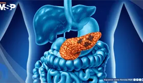 Micropl&aacute;sticos en el agua podr&iacute;an relacionarse con da&ntilde;o pancre&aacute;tico y favorecer la diabetes