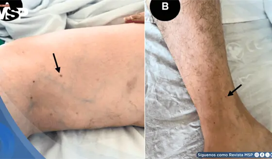 Trombocitopenia severa tras vacuna contra t&eacute;tanos y difteria en mujer con amputaci&oacute;n parcial de falange