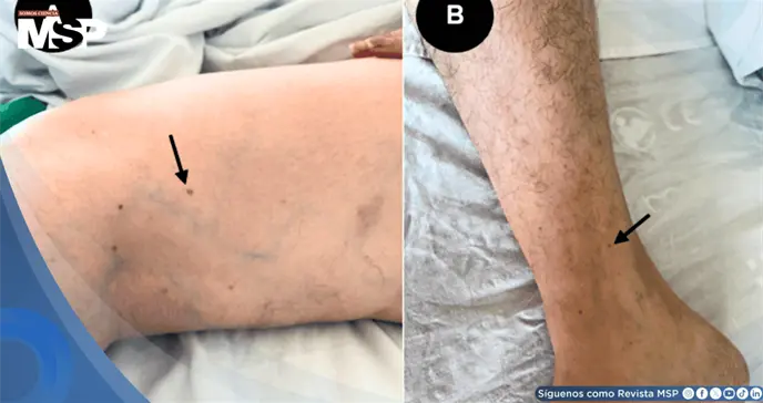 Trombocitopenia severa tras vacuna contra t&eacute;tanos y difteria en mujer con amputaci&oacute;n parcial de falange